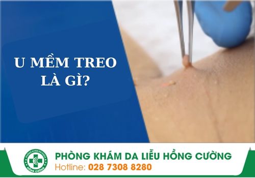 u mềm treo