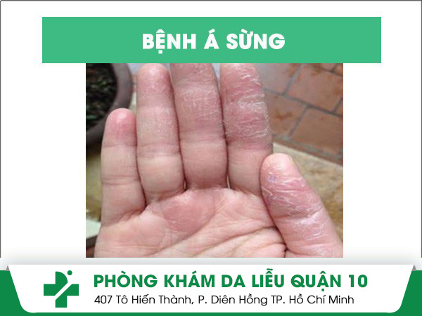 bệnh á sừng