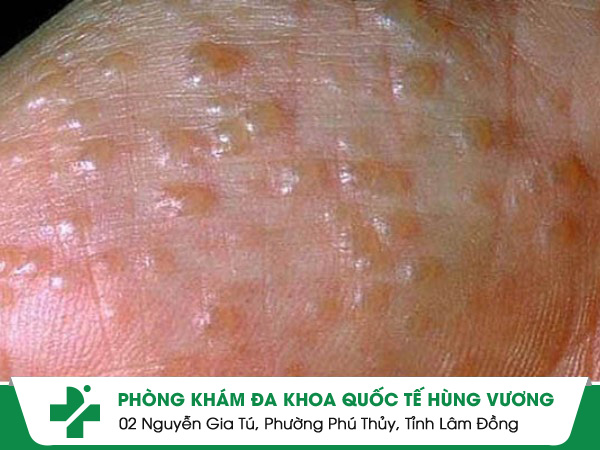 Thế nào là bệnh chàm nước?