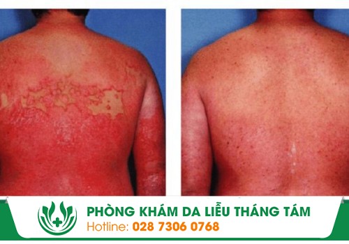 bệnh đỏ da