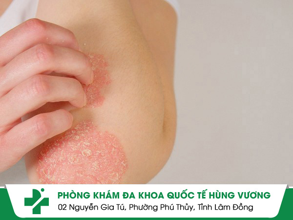 Vảy Nến – Căn Bệnh Mãn Tính Có Thể Đe Dọa Cả Cuộc Đời Nếu Bỏ Qua Giai Đoạn Vàng!