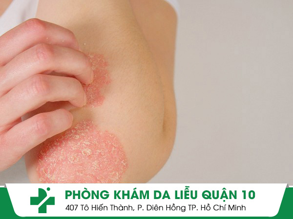 vảy nến