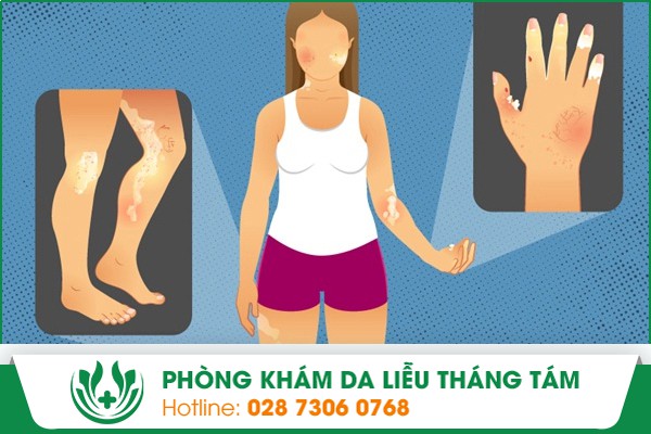bệnh xơ cứng bì toàn thể