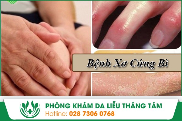bệnh xơ cứng bì