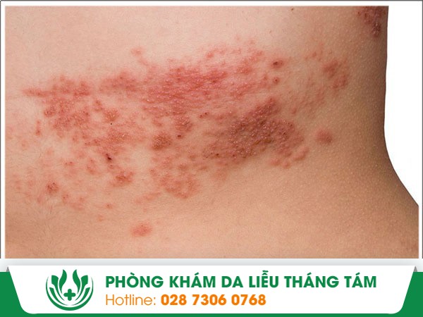 bệnh zona