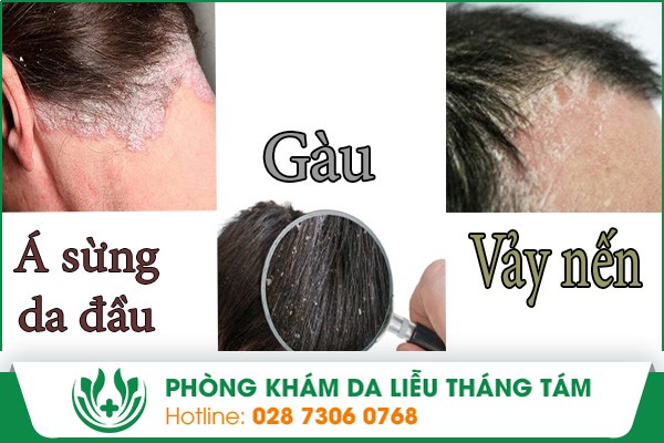 Hình ảnh miêu tả bệnh á sừng, gàu và vảy nến