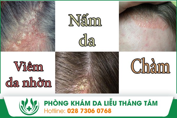 Hình ảnh về viêm da nhờn, nấm da và chàm bội nhiễm