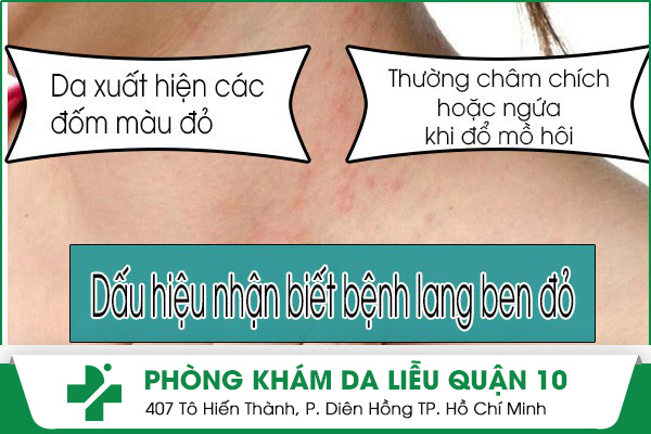 Những dấu hiệu nhận biết mắc bệnh lang ben đỏ