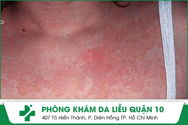 Hình ảnh về bệnh lang ben đỏ