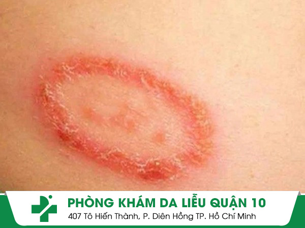 chàm đồng tiền