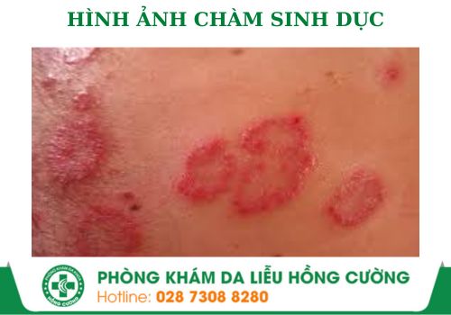 chàm sinh dục