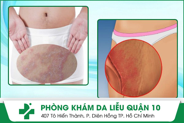 chàm sinh dục