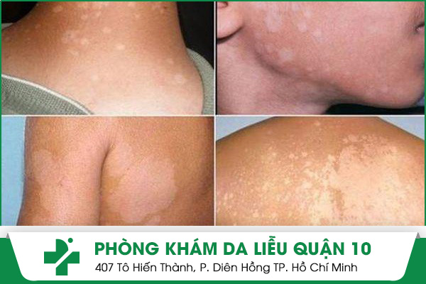 Hình ảnh về bệnh lang ben trắng