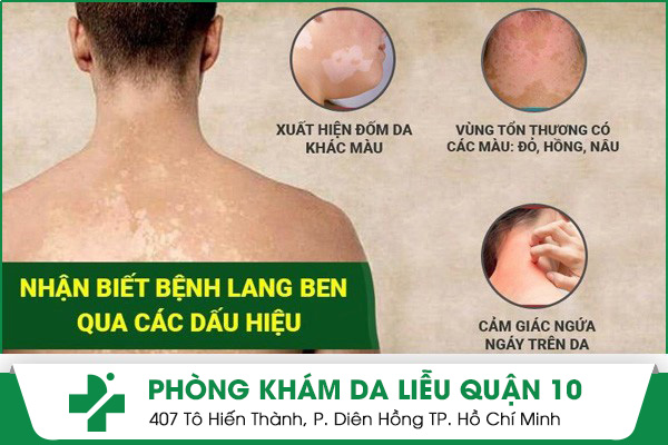 Dấu hiệu nhận biết bệnh lang ben trắng