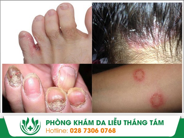 nấm da