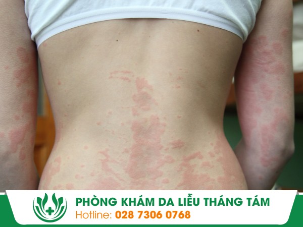 dị ứng mẩn ngứa