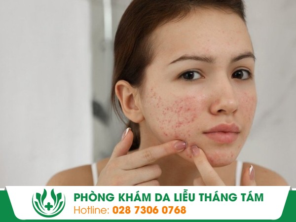 dị ứng mụn