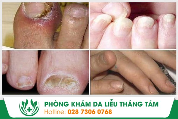 nấm móng