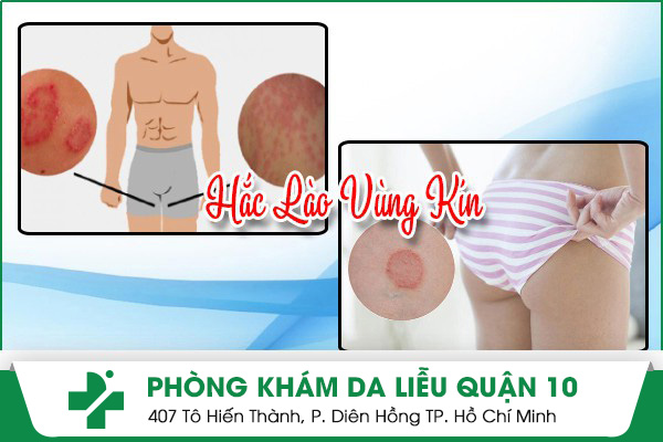 hắc lào vùng kín