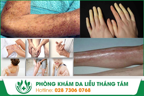 Biểu hiện bên ngoài của bệnh xơ cứng bì