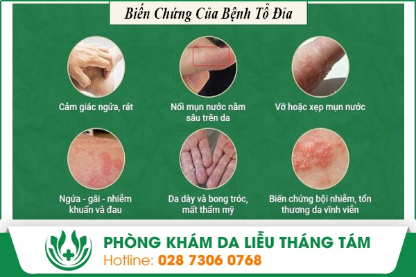 lòng bàn tay ngứa nổi hột