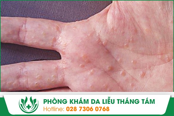 Lòng bàn tay ngứa nổi hột có thể là do bệnh tổ đỉa