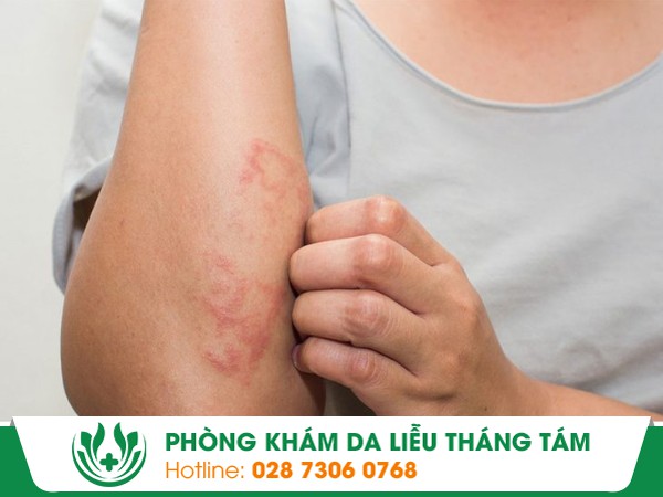mụn nước ngứa