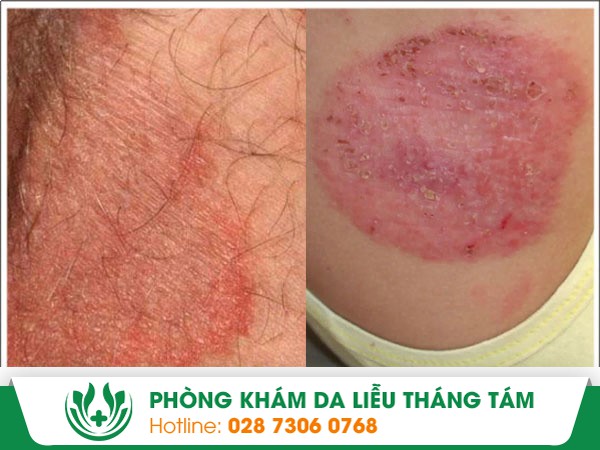nấm háng
