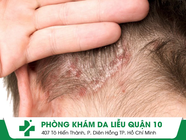 ngứa da đầu