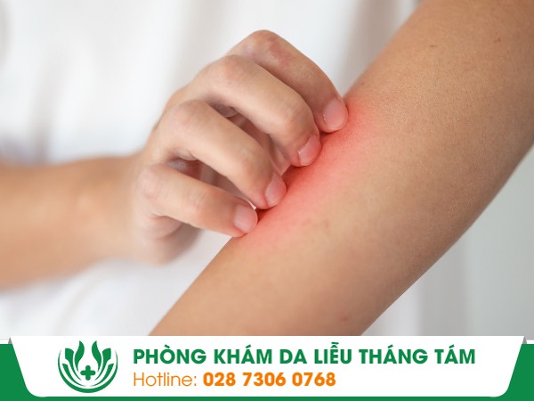 ngứa da, nổi mẩn ngứa