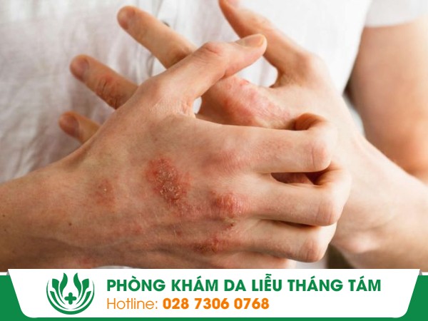 ngứa nổi cục