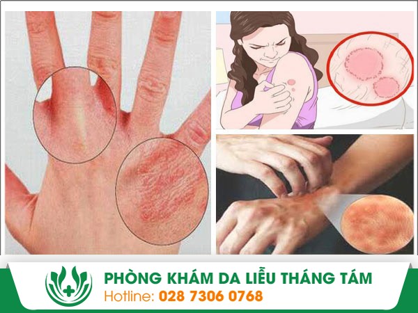 Hình ảnh nhận biết bệnh da tay - cần hết sức cảnh giác
