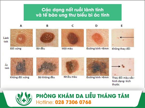 bệnh viện da liễu bắn nốt ruồi thẩm mỹ