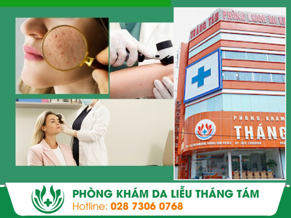 phòng khám da liễu Tháng Tám