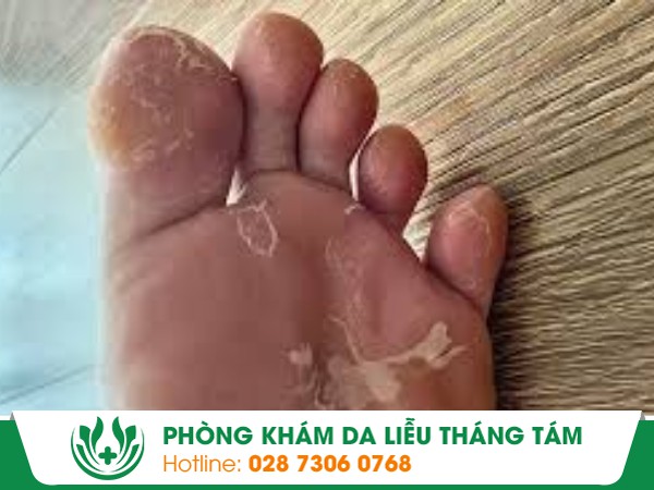 tay chân bị lột da