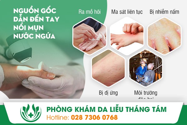 mụn nước tay
