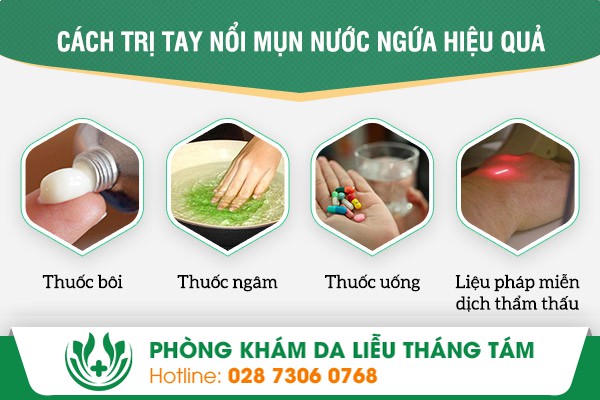 Các phương pháp điều trị tay nổi mụn nước được nhiều chuyên gia hàng đầu khuyên dùng