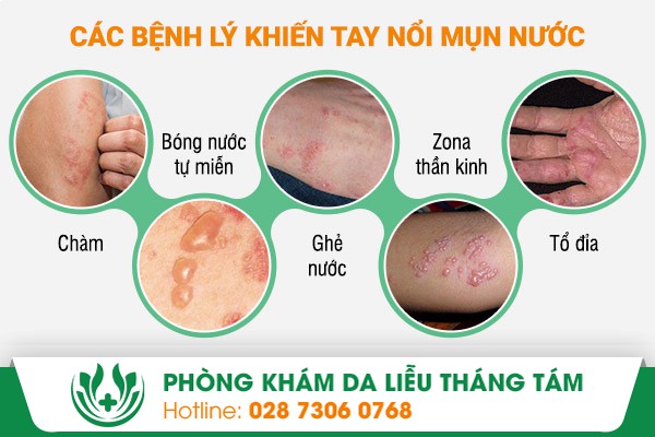 Tay nổi mụn nước là biểu hiện của bệnh gì?