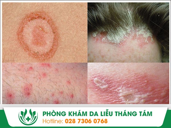 chữa bệnh ngoài da