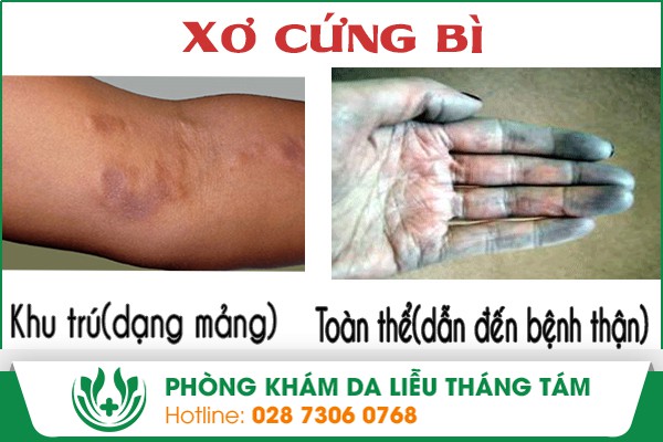 Hình ảnh bệnh xơ cứng bì