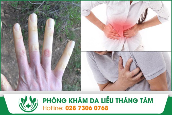 Những triệu chứng biểu hiện bệnh xơ cứng bì