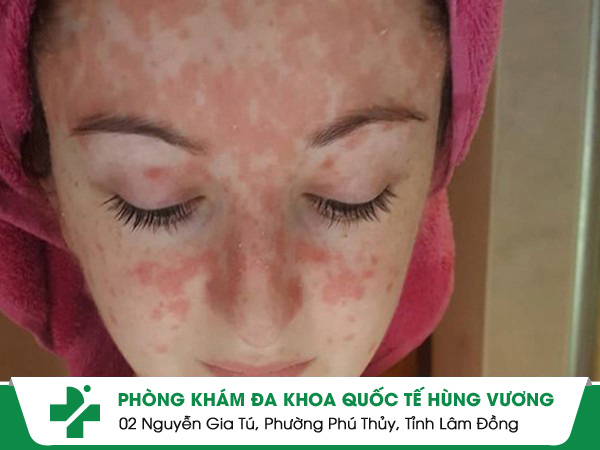 Dấu hiệu nhận biết bệnh vảy nến da mặt và cách điều trị hiệu quả