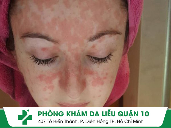 vảy nến da mặt