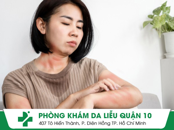 vảy nến toàn thân