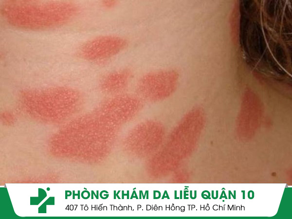 vảy phấn hồng