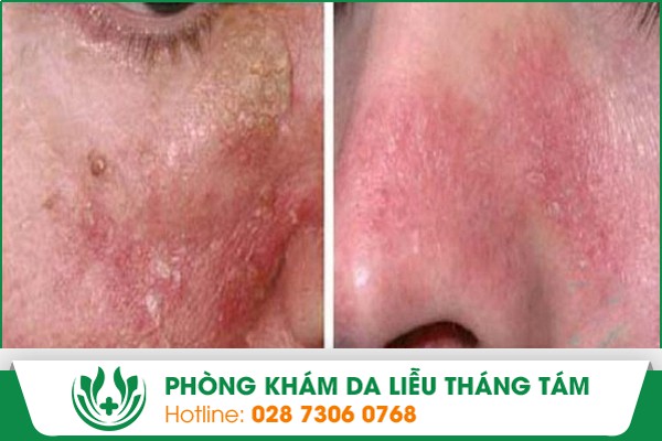 viêm da nhờn