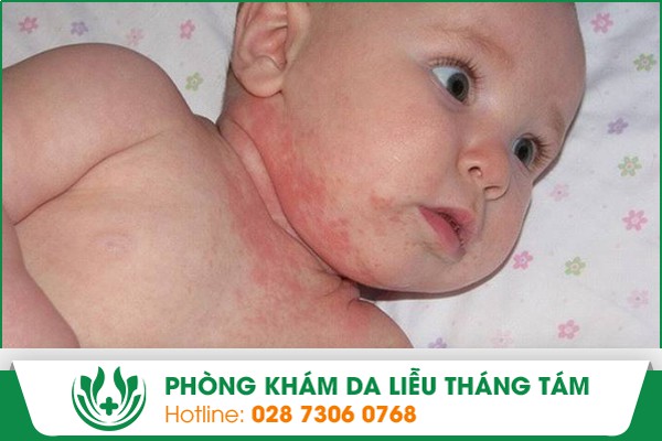 viêm da nhờn