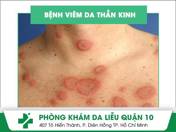 viêm da thần kinh