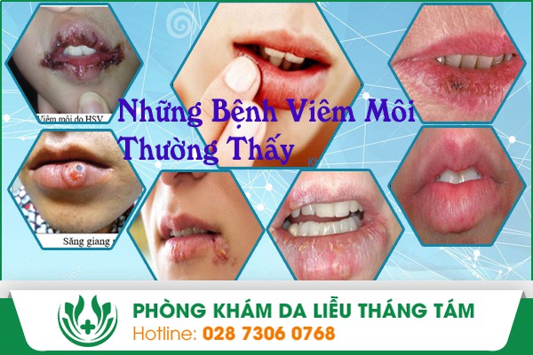 Những bệnh viêm môi thường thấy