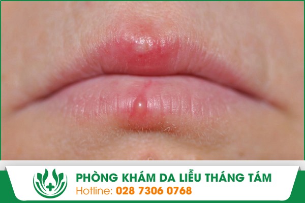 xăm môi nổi mụn nước